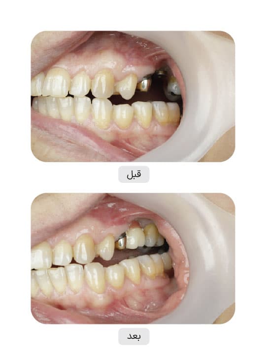تصویر قبل و بعد درمان ایمپلنت دندان، نمونه 1 در ایران ایمپلنت