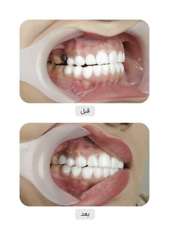 تصویر قبل و بعد درمان ایمپلنت دندان، نمونه 2 در ایران ایمپلنت