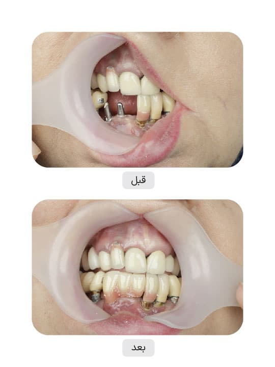 تصویر قبل و بعد درمان ایمپلنت دندان، نمونه 3 در ایران ایمپلنت