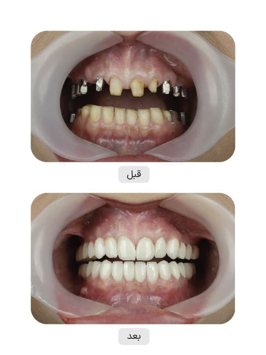 تصویر قبل و بعد درمان ایمپلنت دندان، نمونه 4 در ایران ایمپلنت