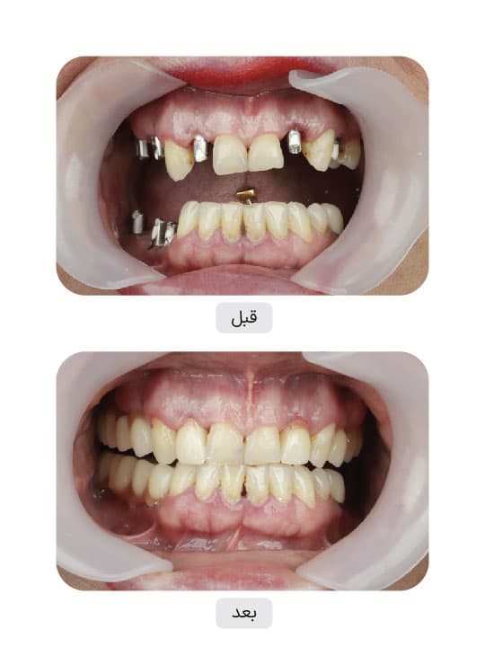 تصویر قبل و بعد درمان ایمپلنت دندان، نمونه 5 در ایران ایمپلنت