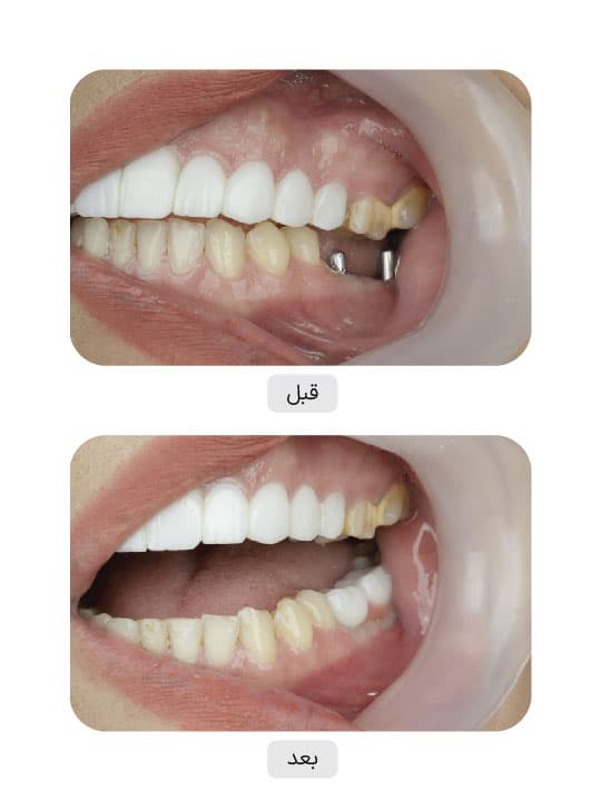 تصویر قبل و بعد درمان ایمپلنت دندان، نمونه 6 در ایران ایمپلنت