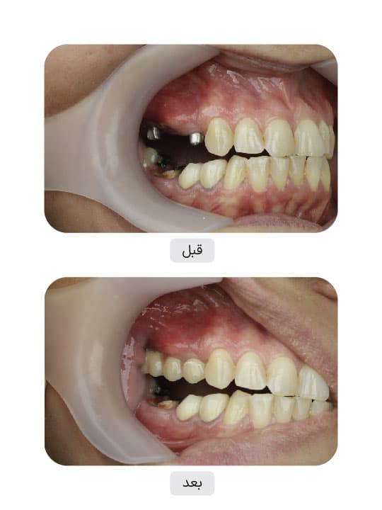 تصویر قبل و بعد درمان ایمپلنت دندان، نمونه 8 در ایران ایمپلنت