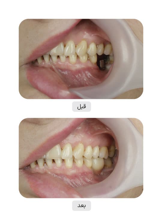 تصویر قبل و بعد درمان ایمپلنت دندان، نمونه 9 در ایران ایمپلنت