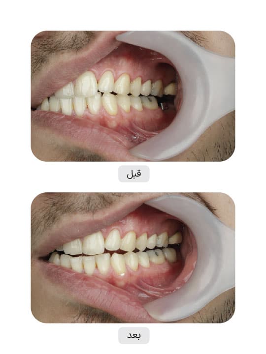 تصویر قبل و بعد درمان ایمپلنت دندان، نمونه 11 در ایران ایمپلنت