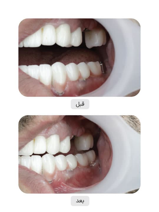 تصویر قبل و بعد درمان ایمپلنت دندان، نمونه 13 در ایران ایمپلنت