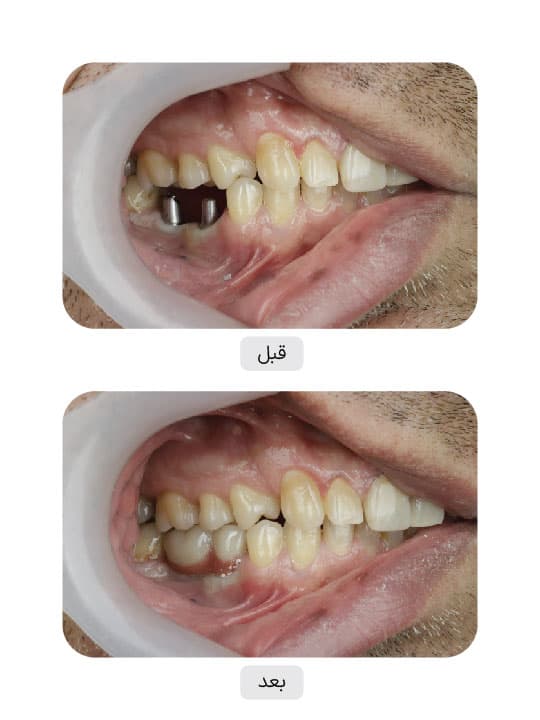 تصویر قبل و بعد درمان ایمپلنت دندان، نمونه 14 در ایران ایمپلنت