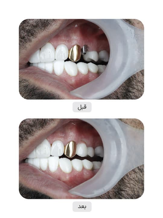 تصویر قبل و بعد درمان ایمپلنت دندان، نمونه 15 در ایران ایمپلنت