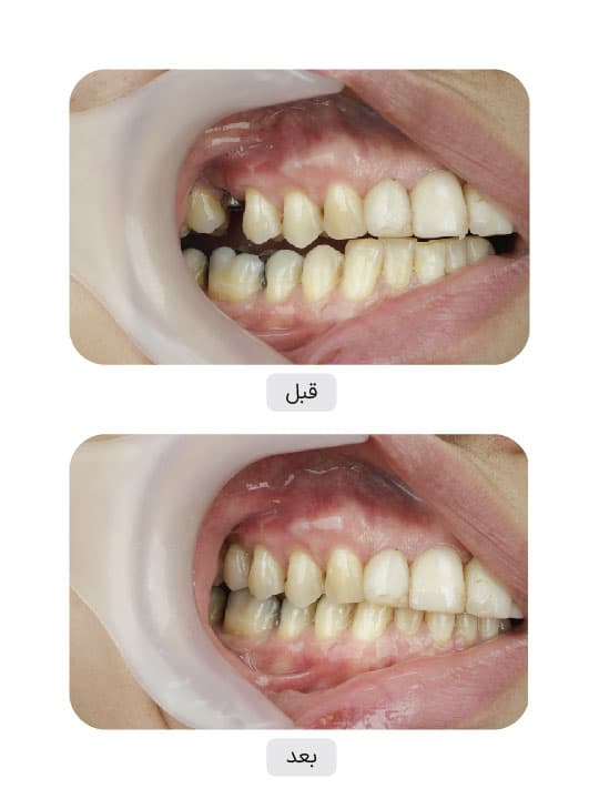 تصویر قبل و بعد درمان ایمپلنت دندان، نمونه 16 در ایران ایمپلنت