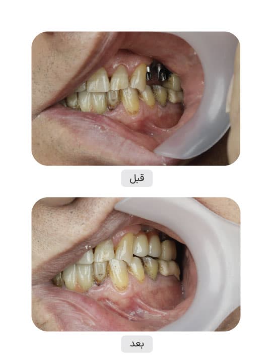تصویر قبل و بعد درمان ایمپلنت دندان، نمونه 18 در ایران ایمپلنت