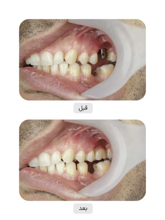 تصویر قبل و بعد درمان ایمپلنت دندان، نمونه 19 در ایران ایمپلنت