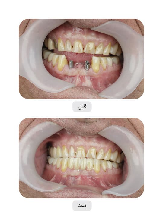 تصویر قبل و بعد درمان ایمپلنت دندان، نمونه 20 در ایران ایمپلنت