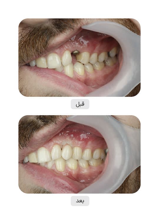 تصویر قبل و بعد درمان ایمپلنت دندان، نمونه 21 در ایران ایمپلنت