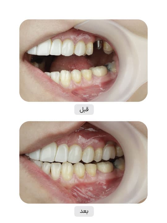 تصویر قبل و بعد درمان ایمپلنت دندان، نمونه 24 در ایران ایمپلنت
