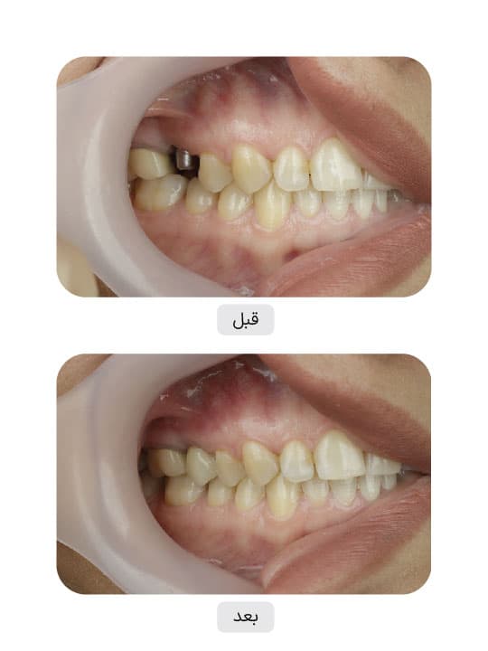 تصویر قبل و بعد درمان ایمپلنت دندان، نمونه 28 در ایران ایمپلنت