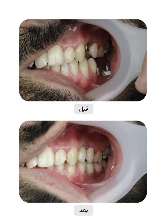 تصویر قبل و بعد درمان ایمپلنت دندان، نمونه 32 در ایران ایمپلنت