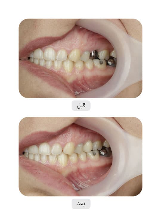 تصویر قبل و بعد درمان ایمپلنت دندان، نمونه 34 در ایران ایمپلنت