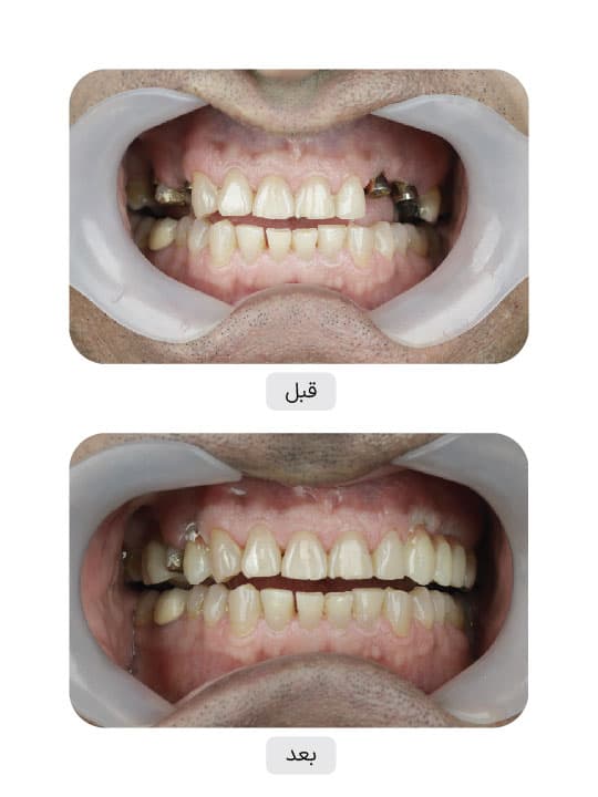 تصویر قبل و بعد درمان ایمپلنت دندان، نمونه 35 در ایران ایمپلنت