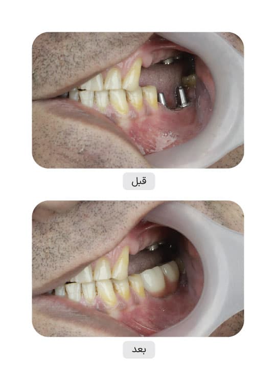 تصویر قبل و بعد درمان ایمپلنت دندان، نمونه 36 در ایران ایمپلنت