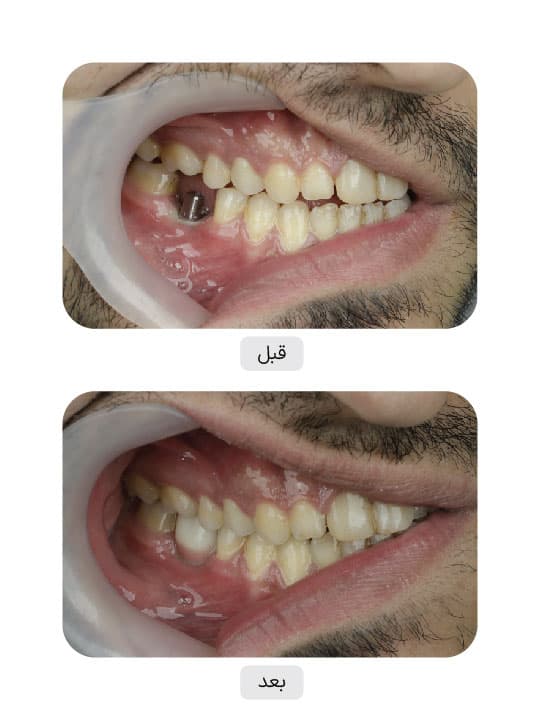 تصویر قبل و بعد درمان ایمپلنت دندان، نمونه 37 در ایران ایمپلنت