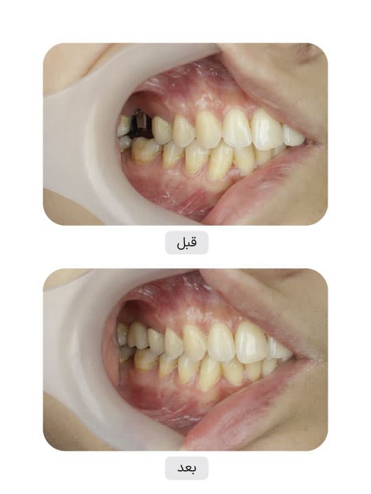 تصویر قبل و بعد درمان ایمپلنت دندان، نمونه 38 در ایران ایمپلنت
