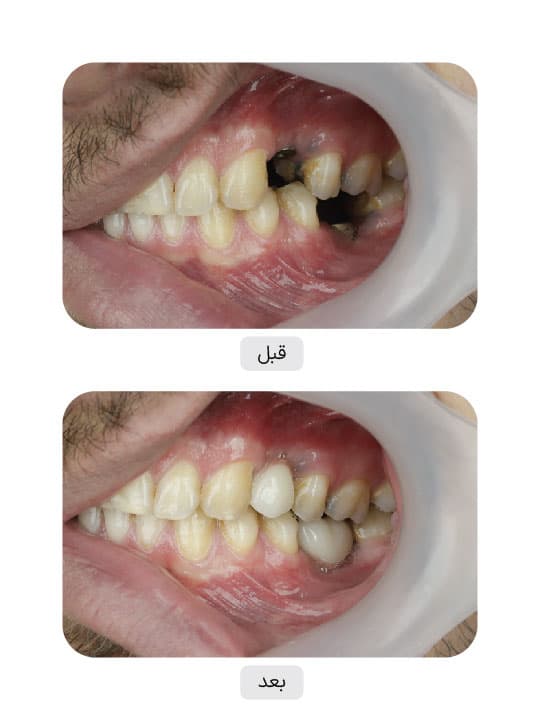 تصویر قبل و بعد درمان ایمپلنت دندان، نمونه 39 در ایران ایمپلنت
