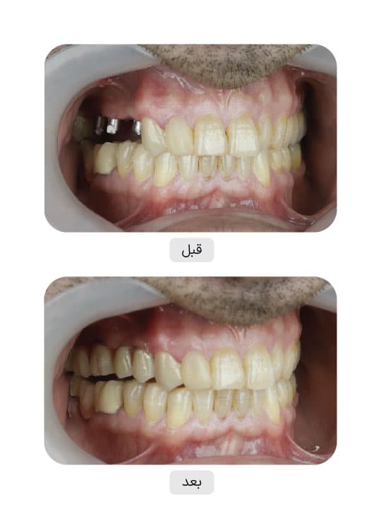 تصویر قبل و بعد درمان ایمپلنت دندان، نمونه 40 در ایران ایمپلنت