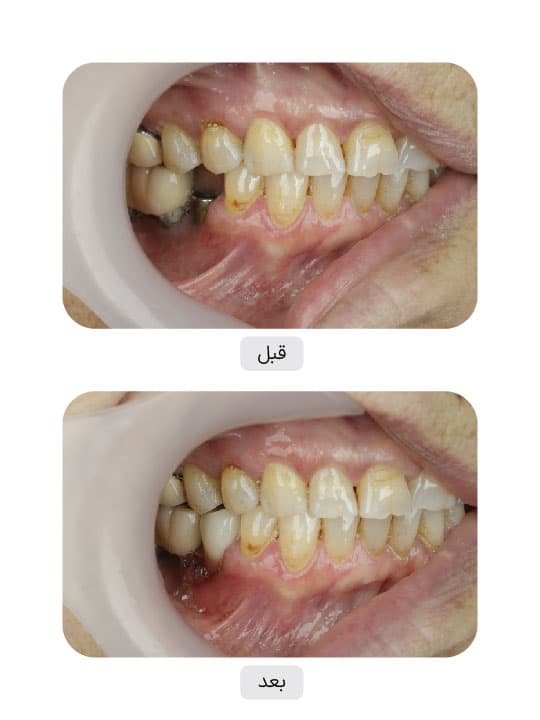 تصویر قبل و بعد درمان ایمپلنت دندان، نمونه 42 در ایران ایمپلنت