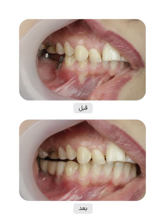 تصویر قبل و بعد درمان ایمپلنت دندان، نمونه 43 در ایران ایمپلنت
