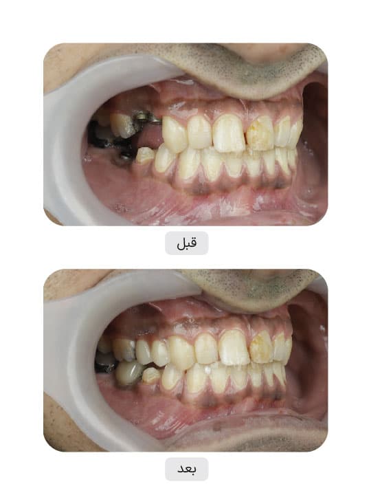 تصویر قبل و بعد درمان ایمپلنت دندان، نمونه 44 در ایران ایمپلنت