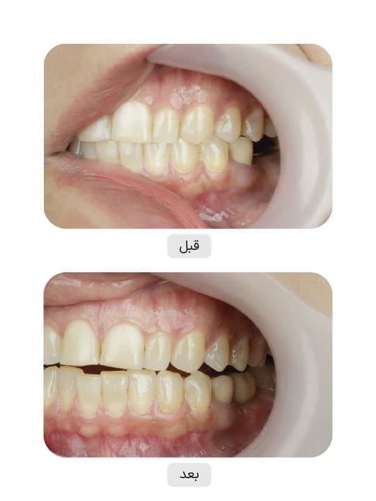 تصویر قبل و بعد درمان ایمپلنت دندان، نمونه 45 در ایران ایمپلنت