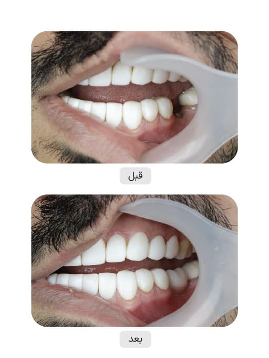تصویر قبل و بعد درمان ایمپلنت دندان، نمونه 47 در ایران ایمپلنت
