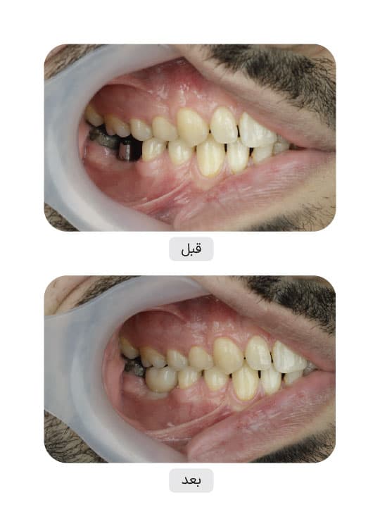 تصویر قبل و بعد درمان ایمپلنت دندان، نمونه 50 در ایران ایمپلنت