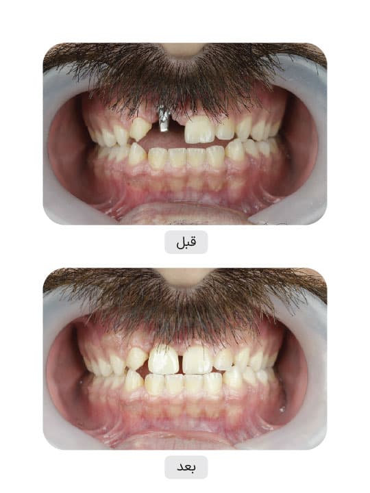 تصویر قبل و بعد درمان ایمپلنت دندان، نمونه 51 در ایران ایمپلنت