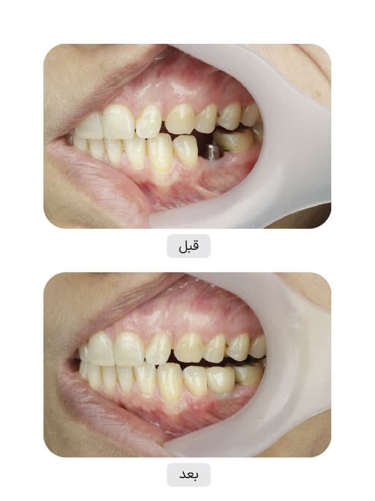 تصویر قبل و بعد درمان ایمپلنت دندان، نمونه 52 در ایران ایمپلنت