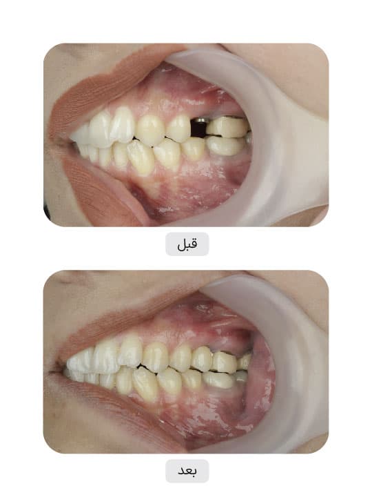 تصویر قبل و بعد درمان ایمپلنت دندان، نمونه 53 در ایران ایمپلنت