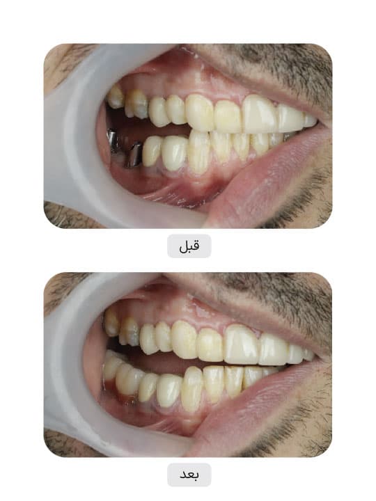 تصویر قبل و بعد درمان ایمپلنت دندان، نمونه 55 در ایران ایمپلنت