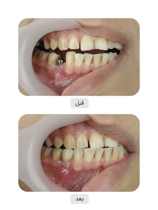 تصویر قبل و بعد درمان ایمپلنت دندان، نمونه 58 در ایران ایمپلنت