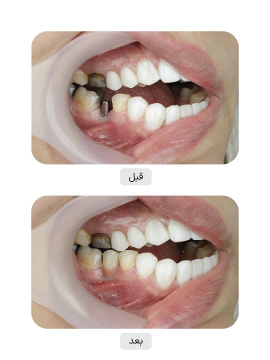 تصویر قبل و بعد درمان ایمپلنت دندان، نمونه 59 در ایران ایمپلنت
