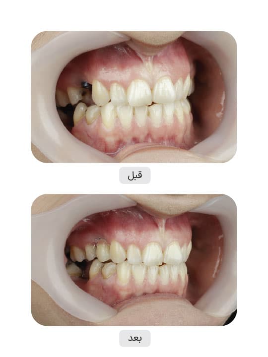 تصویر قبل و بعد درمان ایمپلنت دندان، نمونه 61 در ایران ایمپلنت