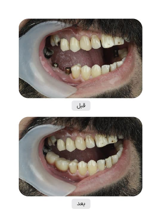 تصویر قبل و بعد درمان ایمپلنت دندان، نمونه 62 در ایران ایمپلنت