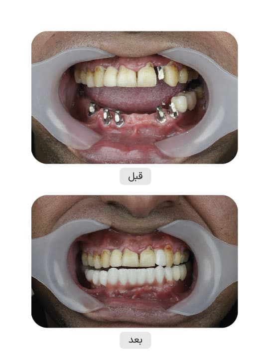 تصویر قبل و بعد درمان ایمپلنت دندان، نمونه 64 در ایران ایمپلنت