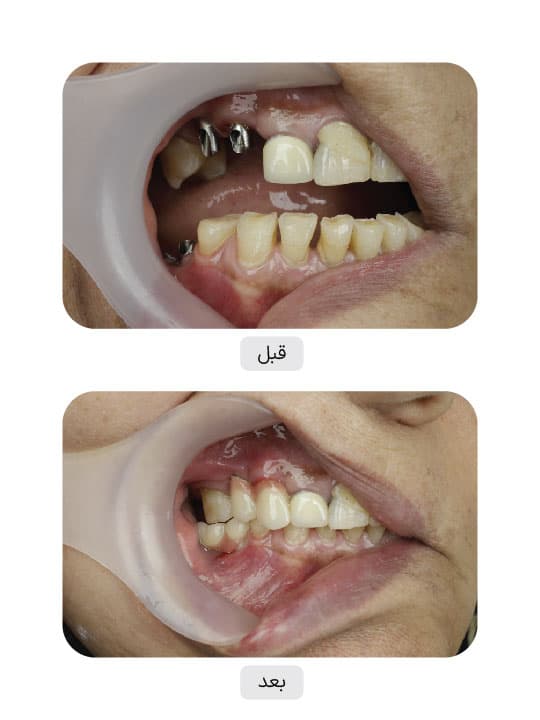 تصویر قبل و بعد درمان ایمپلنت دندان، نمونه 65 در ایران ایمپلنت