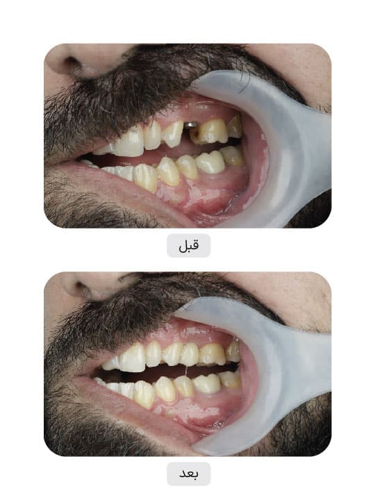 تصویر قبل و بعد درمان ایمپلنت دندان، نمونه 66 در ایران ایمپلنت