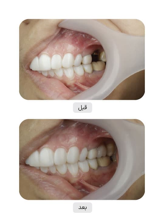 تصویر قبل و بعد درمان ایمپلنت دندان، نمونه 67 در ایران ایمپلنت