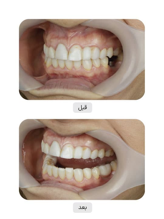 تصویر قبل و بعد درمان ایمپلنت دندان، نمونه 68 در ایران ایمپلنت