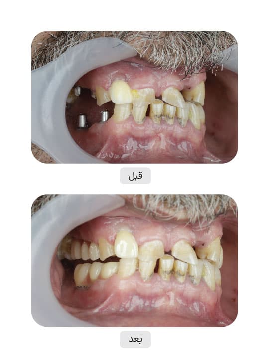 تصویر قبل و بعد درمان ایمپلنت دندان، نمونه 69 در ایران ایمپلنت