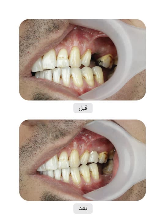 تصویر قبل و بعد درمان ایمپلنت دندان، نمونه 71 در ایران ایمپلنت