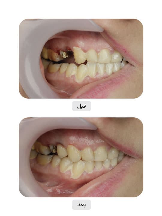تصویر قبل و بعد درمان ایمپلنت دندان، نمونه 72 در ایران ایمپلنت