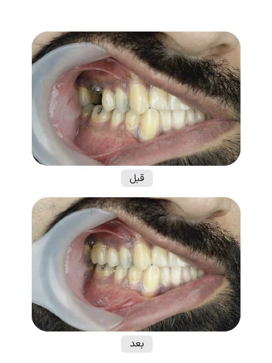 تصویر قبل و بعد درمان ایمپلنت دندان، نمونه 73 در ایران ایمپلنت